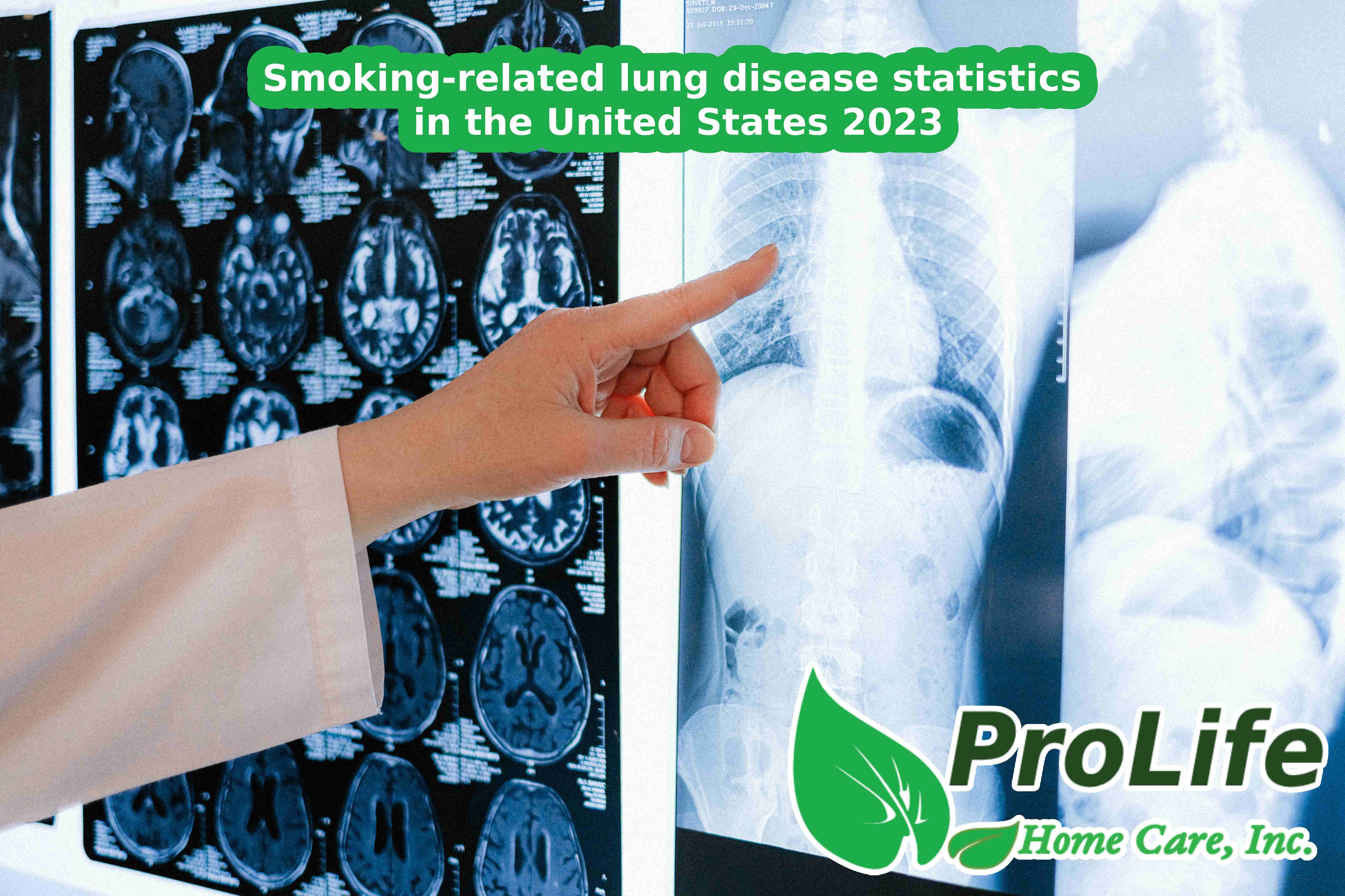 Smoking-related lung disease statistics in the United States 2023