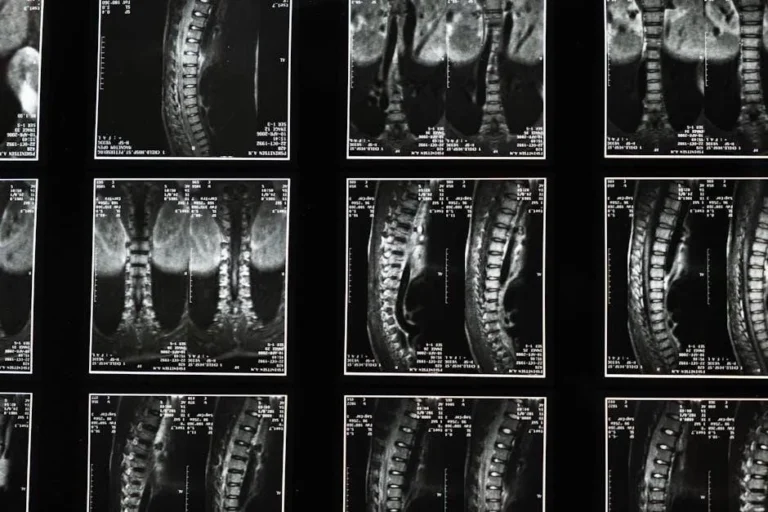Critical Care: Skilled Nursing for NYC Veterans with ALS or Spinal Injuries